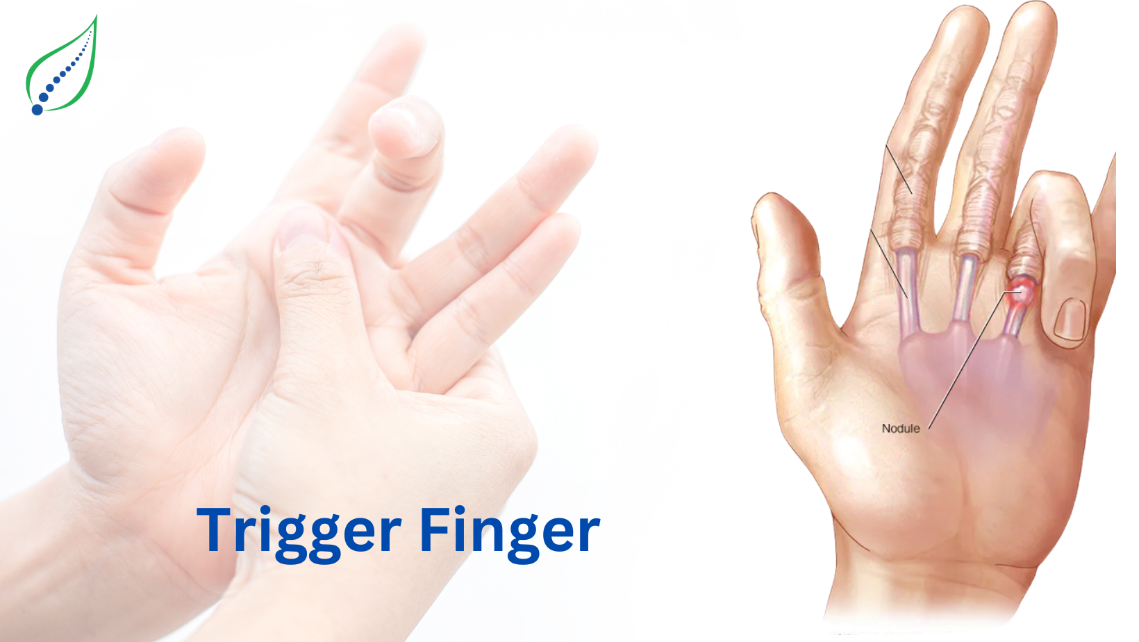 Trigger Finger